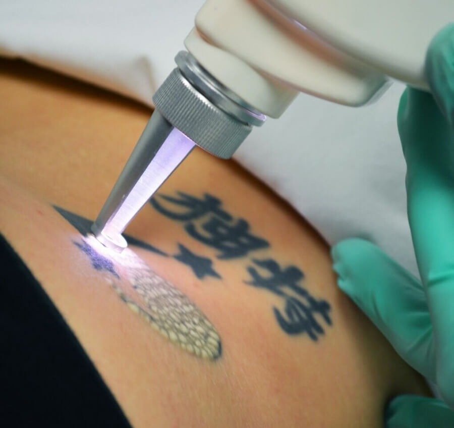 Лазерное удаление татуировок PicoCare